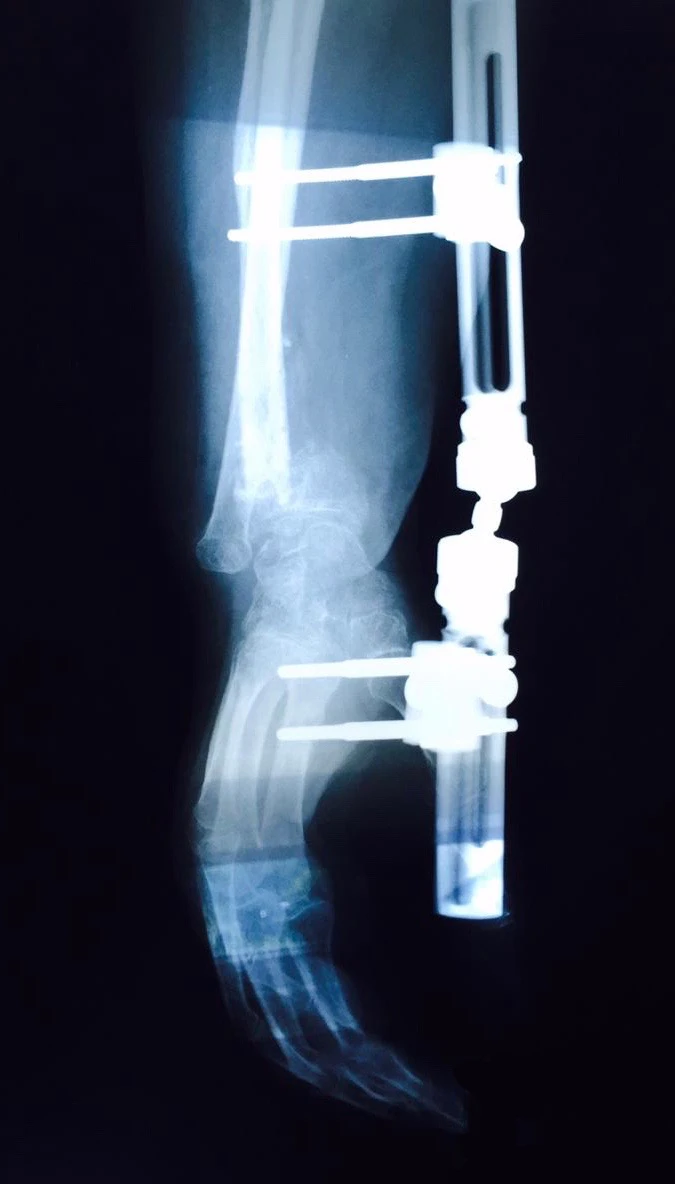 radiografia de un brazo con protesis